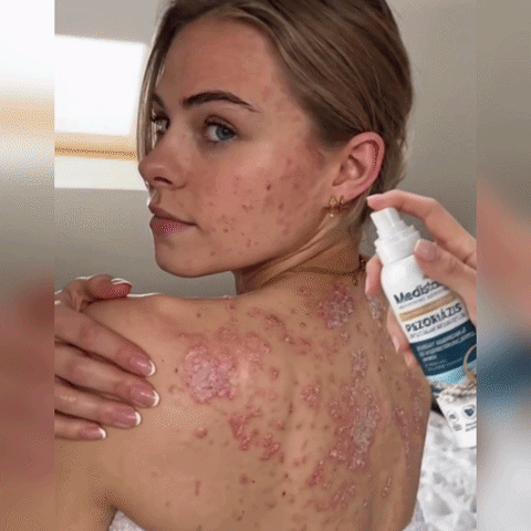 🔥🔥Medistart® POSEBNA NEGA KOŽE PRI LUSKAVICI