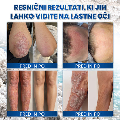 🔥🔥Medistart® POSEBNA NEGA KOŽE PRI LUSKAVICI