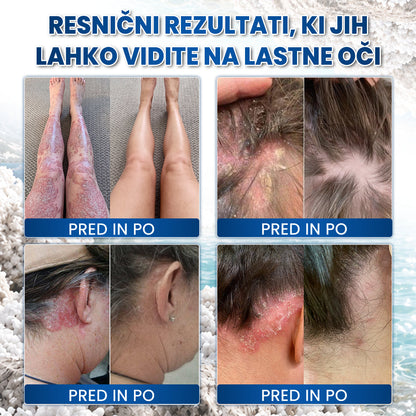 🔥🔥Medistart® POSEBNA NEGA KOŽE PRI LUSKAVICI