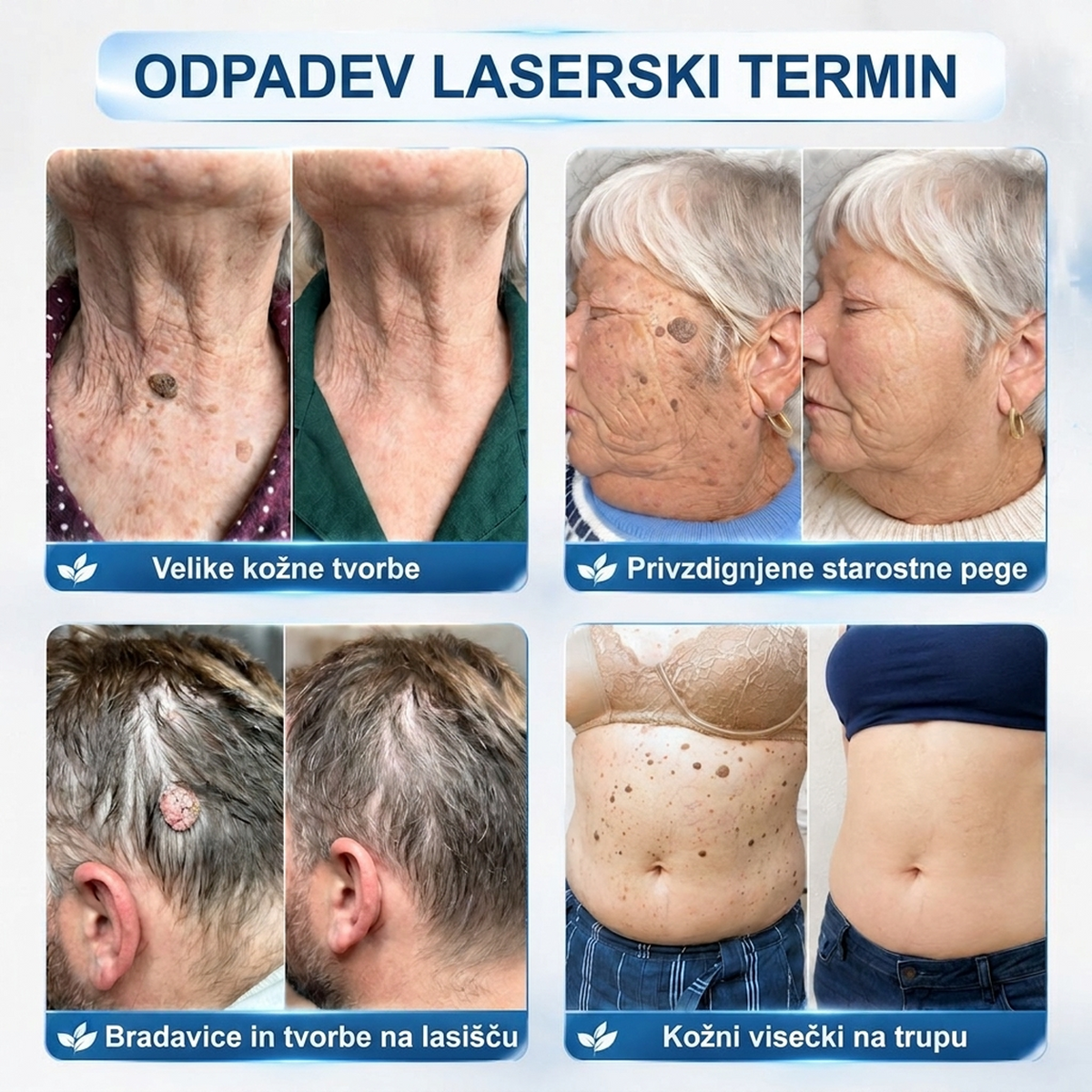 PuraCure®👩‍⚕️ Rezultati so vidni že v 7 dneh! Valjček za odstranjevanje bradavic in drugih kožnih težav | Neboleče in minimalno razmaže.