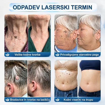 PuraCure®👩‍⚕️ Rezultati so vidni že v 7 dneh! Valjček za odstranjevanje bradavic in drugih kožnih težav | Neboleče in minimalno razmaže.