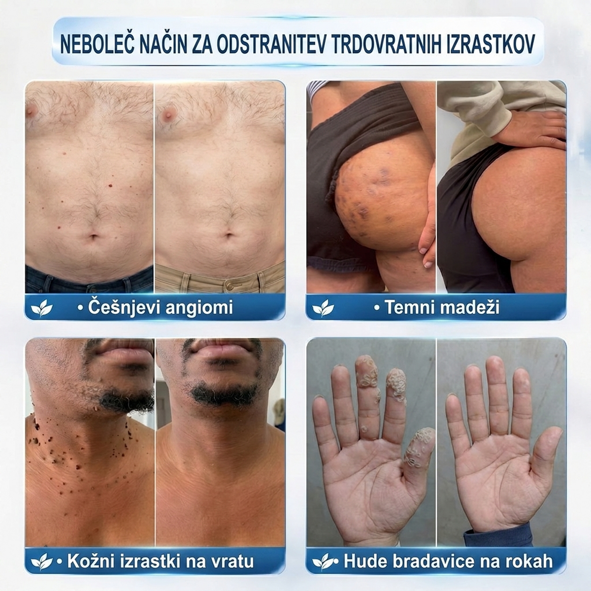 PuraCure®👩‍⚕️ Rezultati so vidni že v 7 dneh! Valjček za odstranjevanje bradavic in drugih kožnih težav | Neboleče in minimalno razmaže.