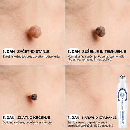 PuraCure®👩‍⚕️ Rezultati so vidni že v 7 dneh! Valjček za odstranjevanje bradavic in drugih kožnih težav | Neboleče in minimalno razmaže.